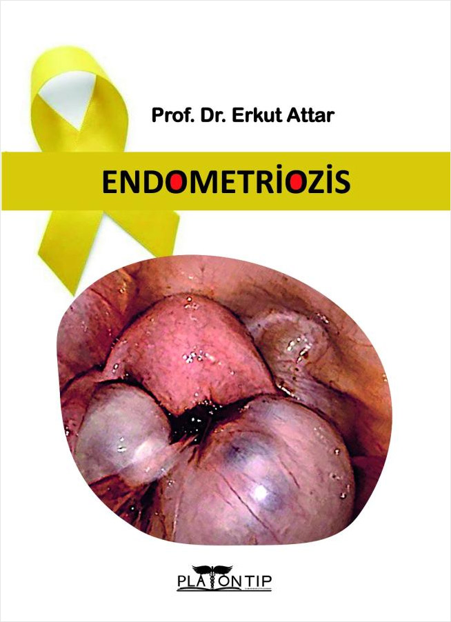 Endometriozis (Ciltli)